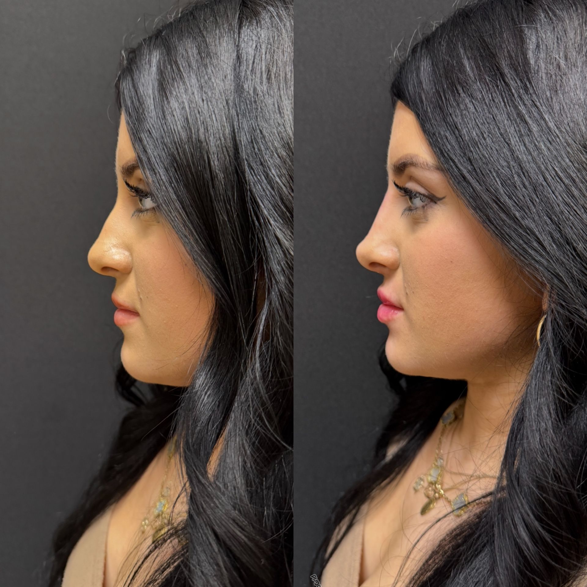 Side profile comparison of the same woman with dark hair against a gray background