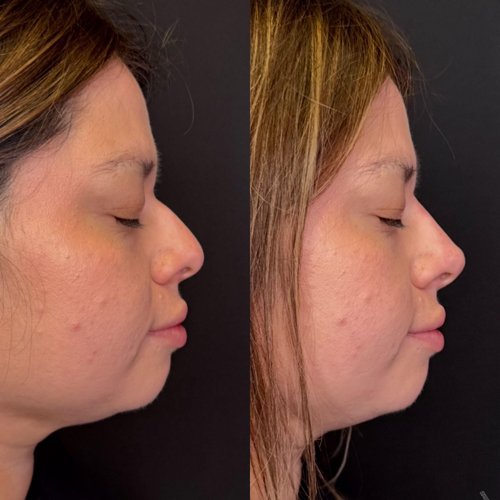 Side-by-side profile photos of a woman before and after facial contouring, against a dark background