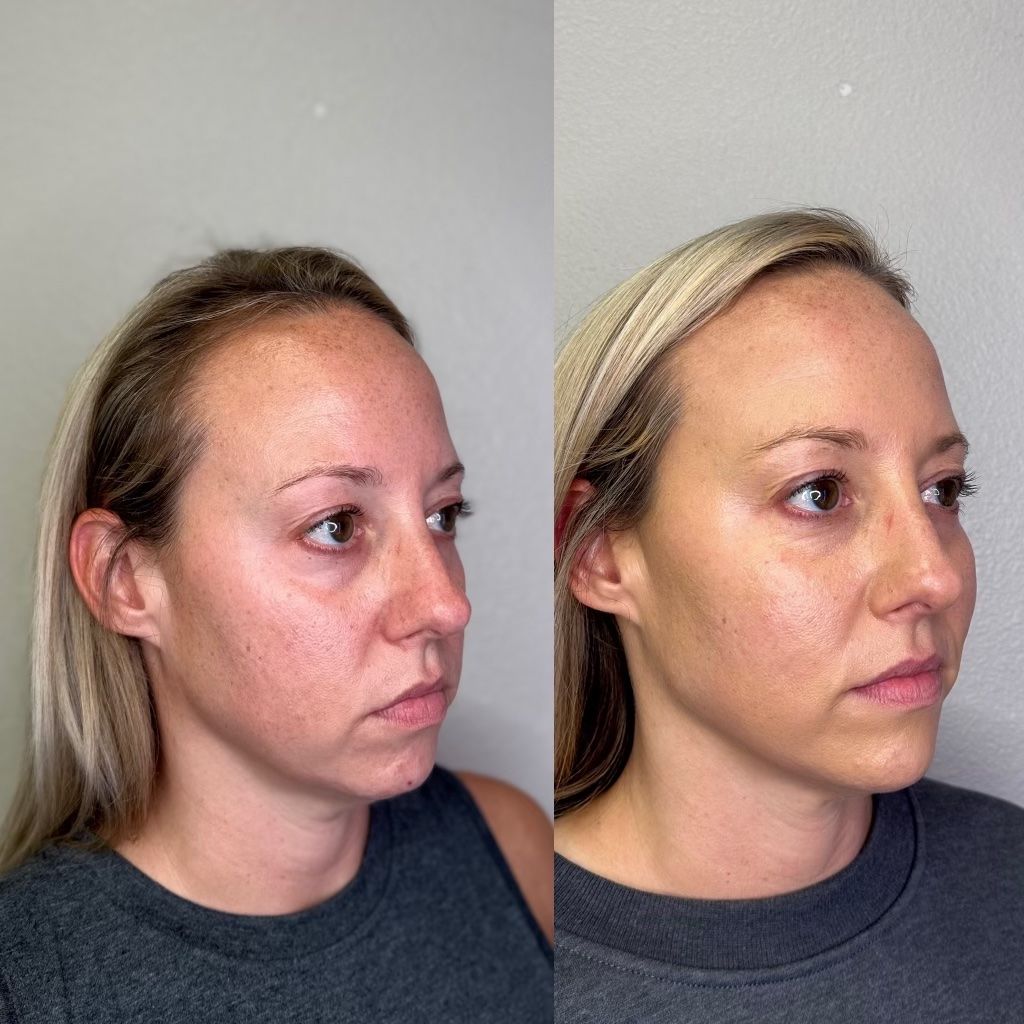 Side-by-side profile photos of a woman against a plain gray background, showing before-and-after facial changes.