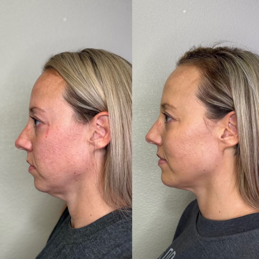 Side-by-side profile photos of a woman before and after a facial procedure.
