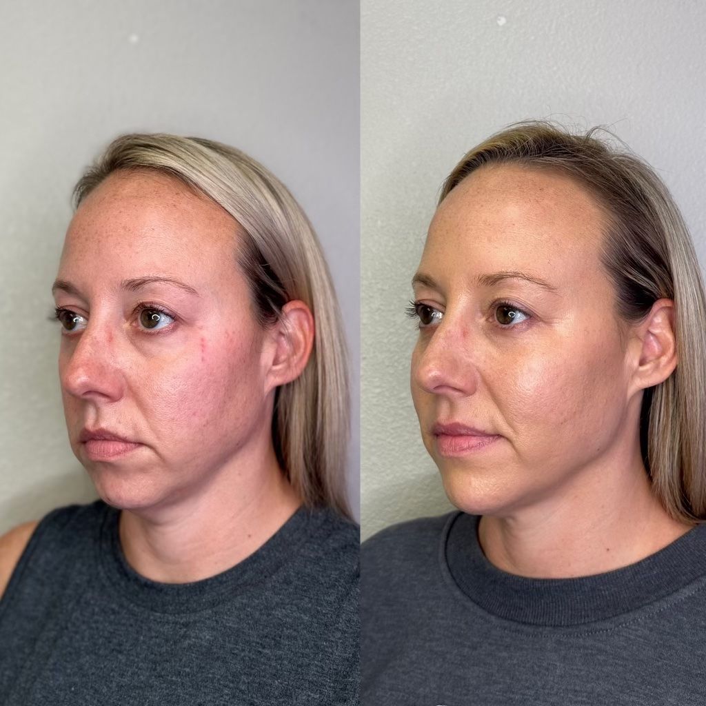 Side-by-side profile photos of a woman, showing skin before and after treatment.