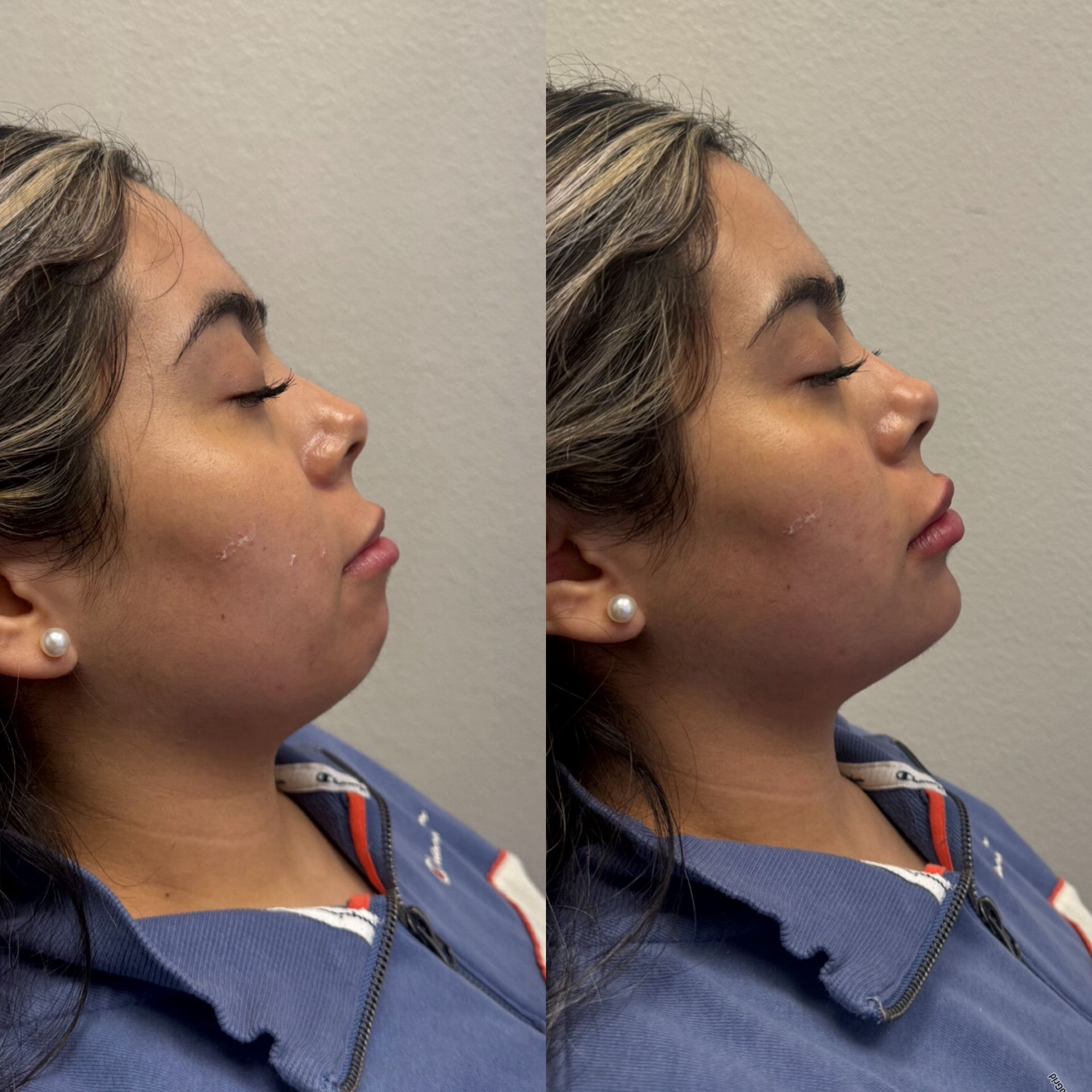 Side-by-side profile photos of a woman with her eyes closed, wearing a blue top against a plain wall.