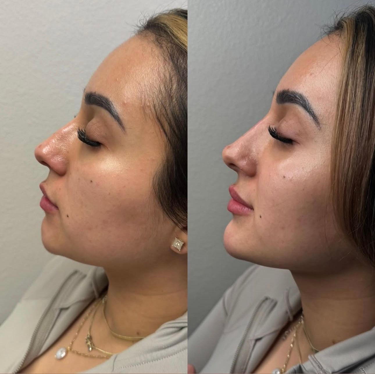 Side-by-side profile portraits of a person before and after facial profile enhancement.