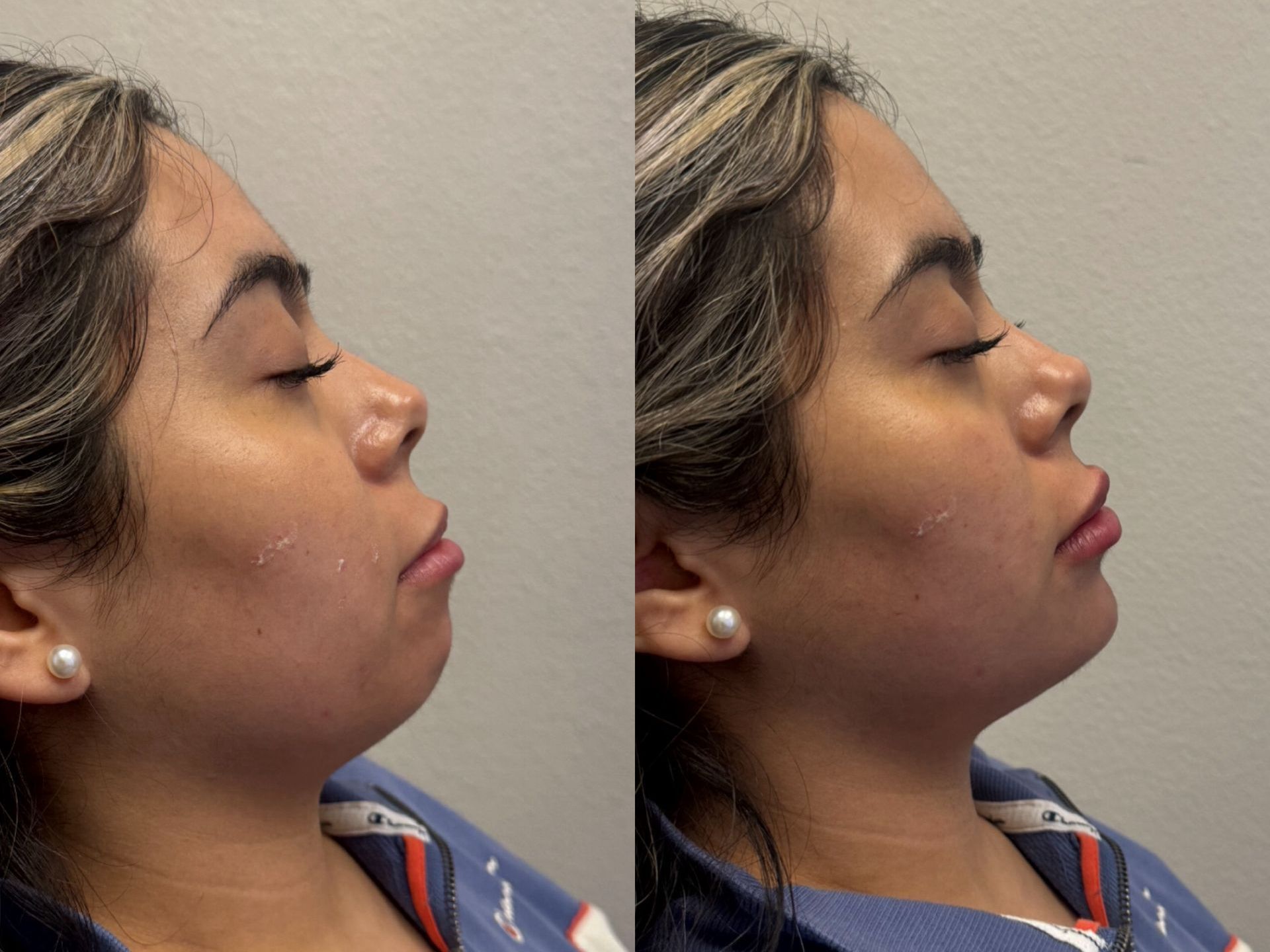 Side profile of a person with eyes closed, shown in two side-by-side views against a plain wall.