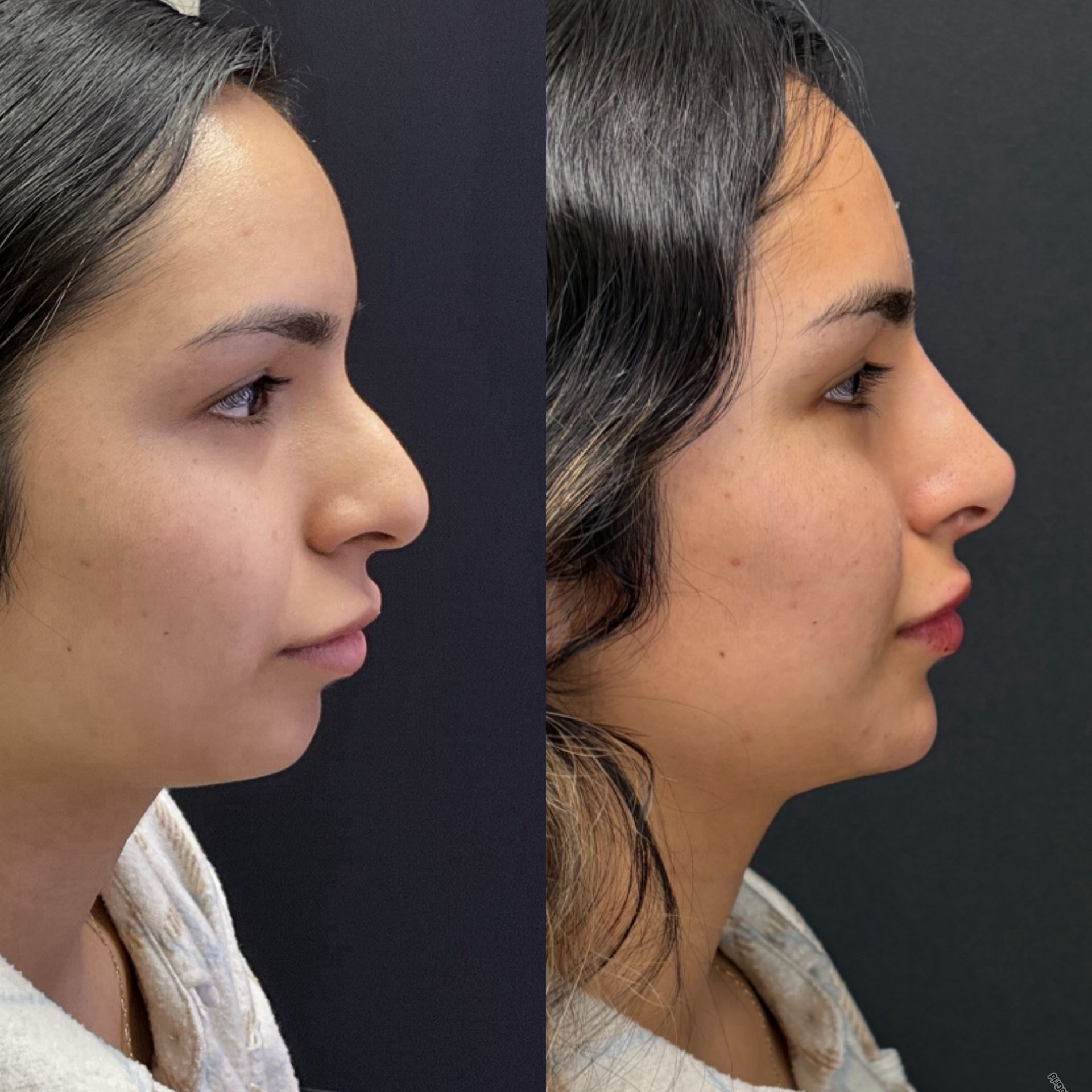 Side-by-side profile portraits of a woman, showing before and after facial appearance.