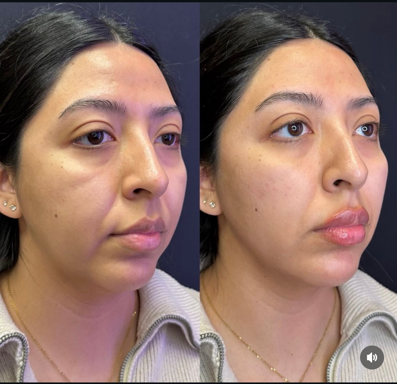 Side-by-side facial profile photos showing a woman before and after makeup or skincare treatment