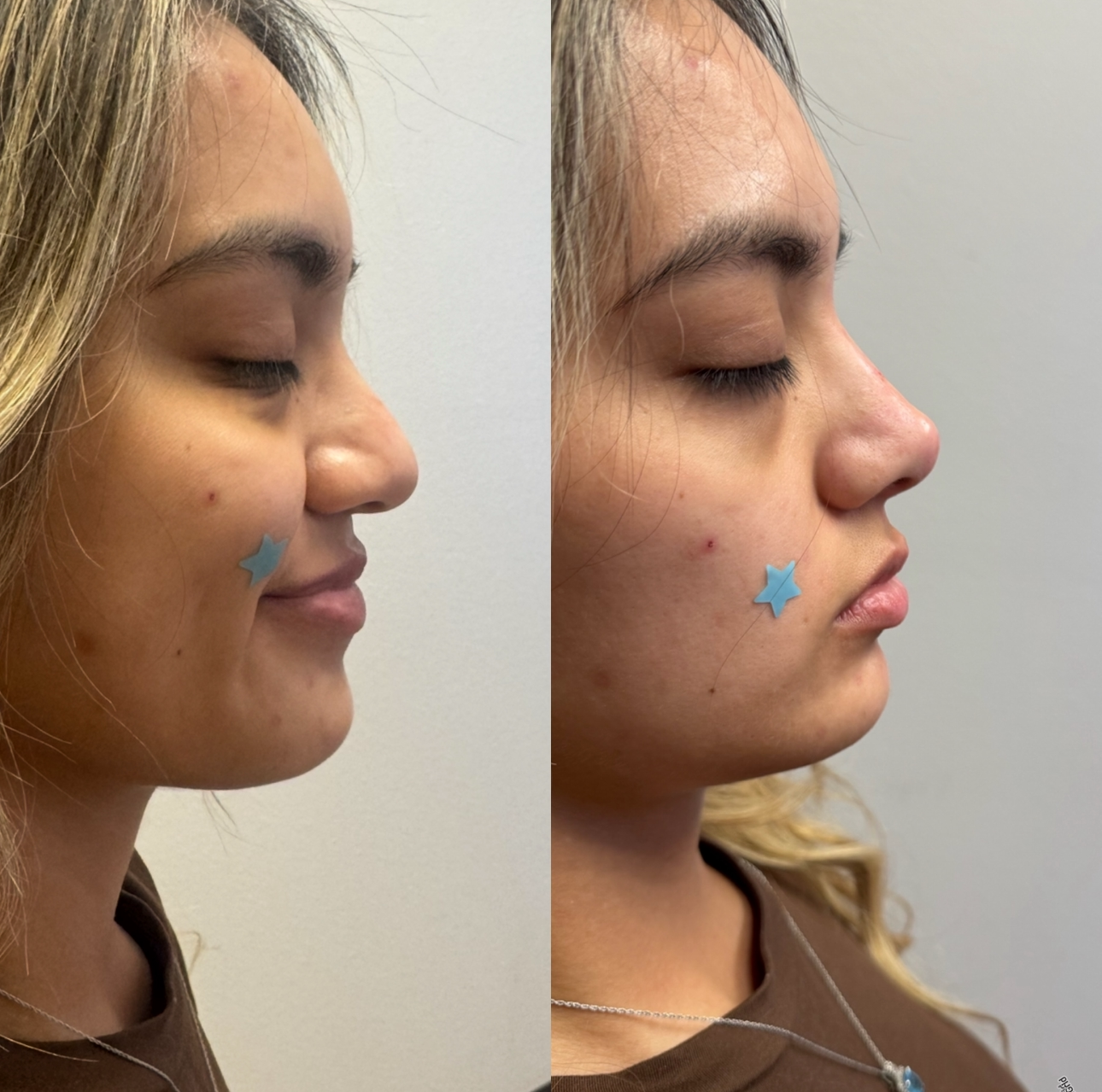 Side-by-side profile of the same person with closed eyes; one cheek has a blue star sticker.