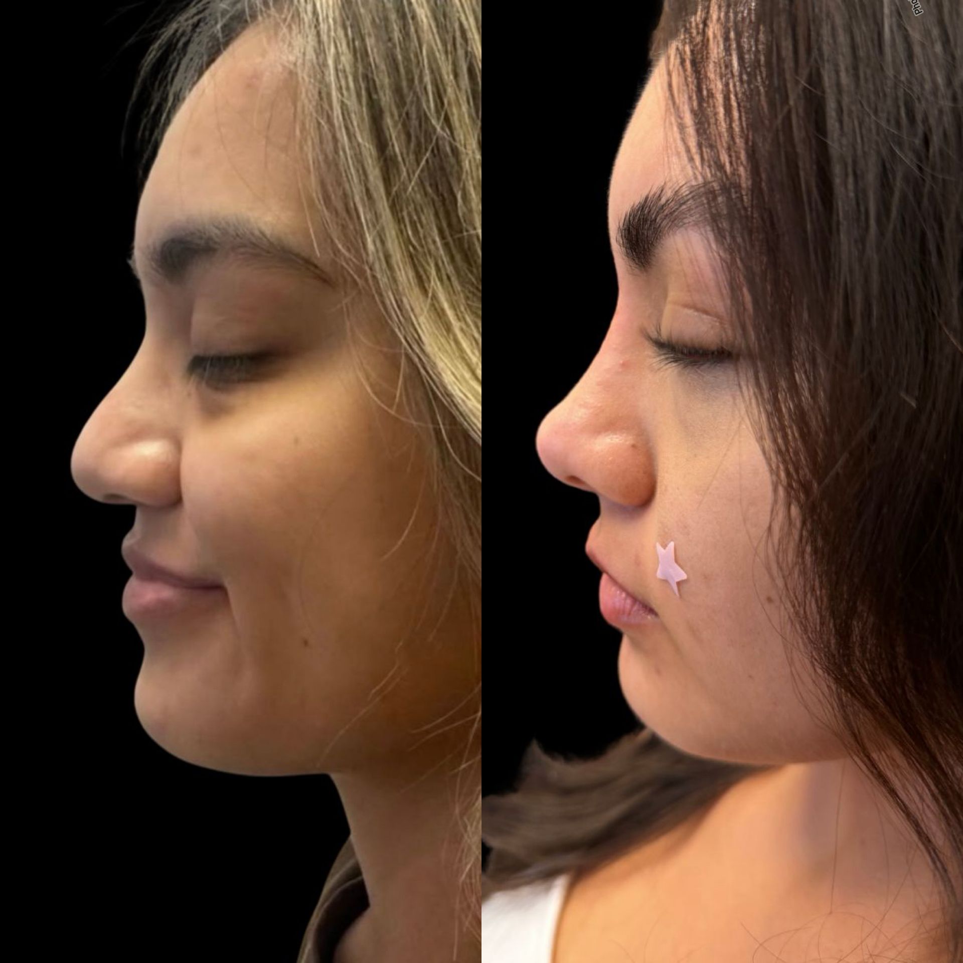 Side-by-side profile close-ups of a smiling person, one with a visible nose contour effect and a small star sticker.