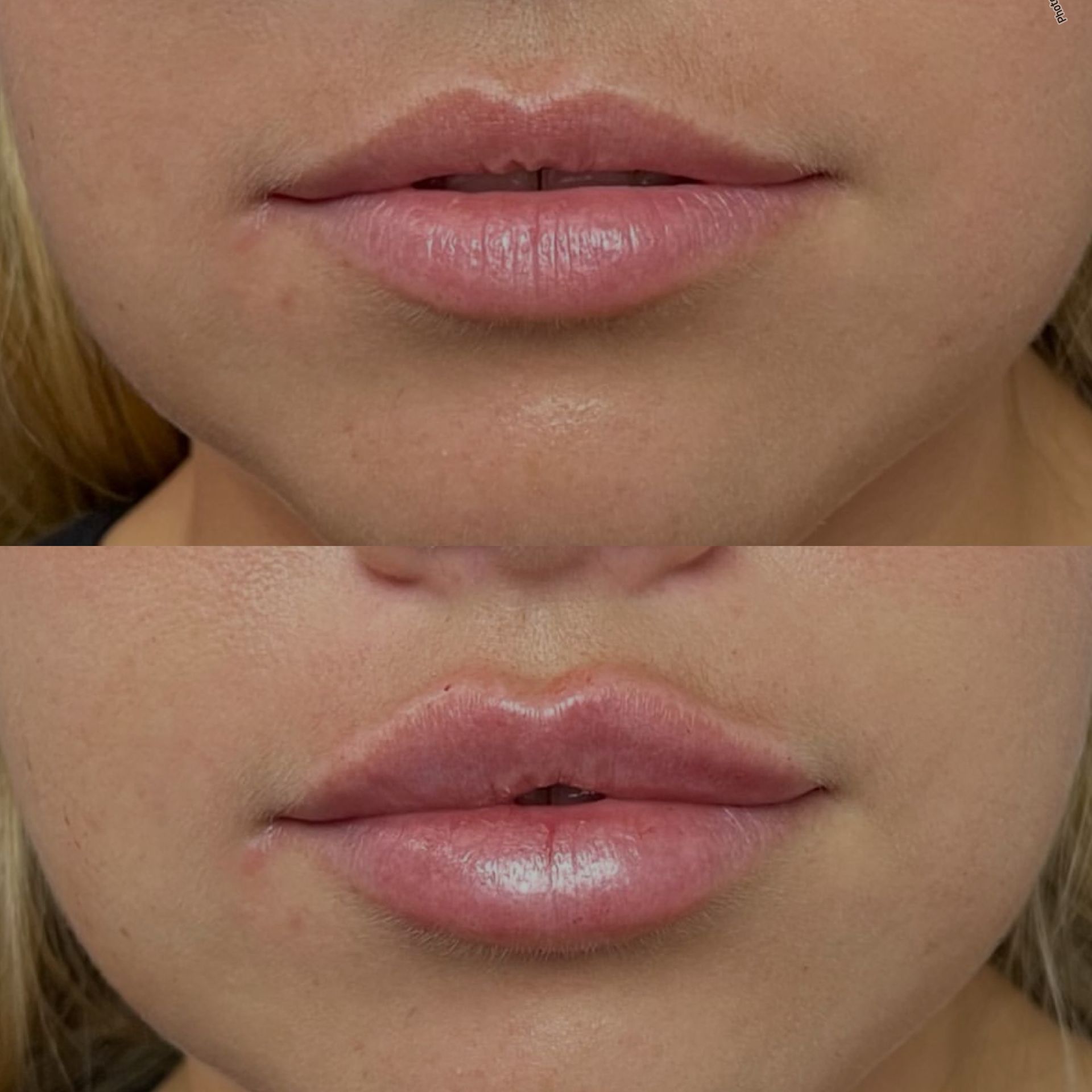 Close-up of lips before and after injection, showing fuller, swollen bottom lip
