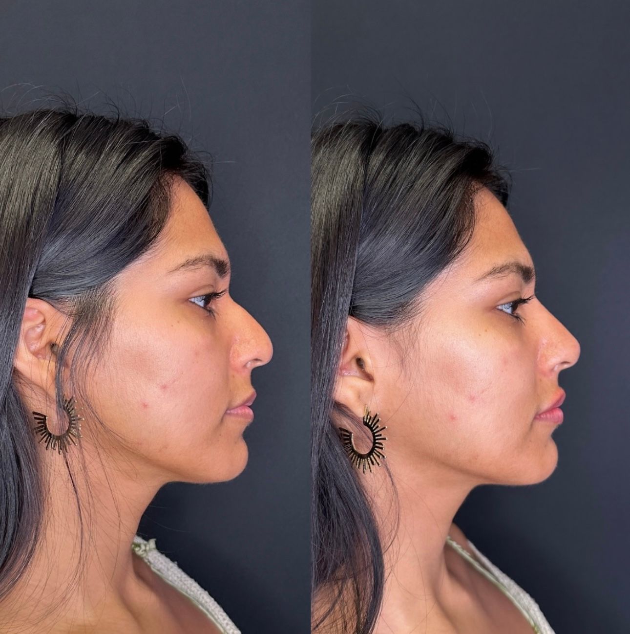 Side-by-side profile photos of a woman against a dark background, showing face and jawline from two angles