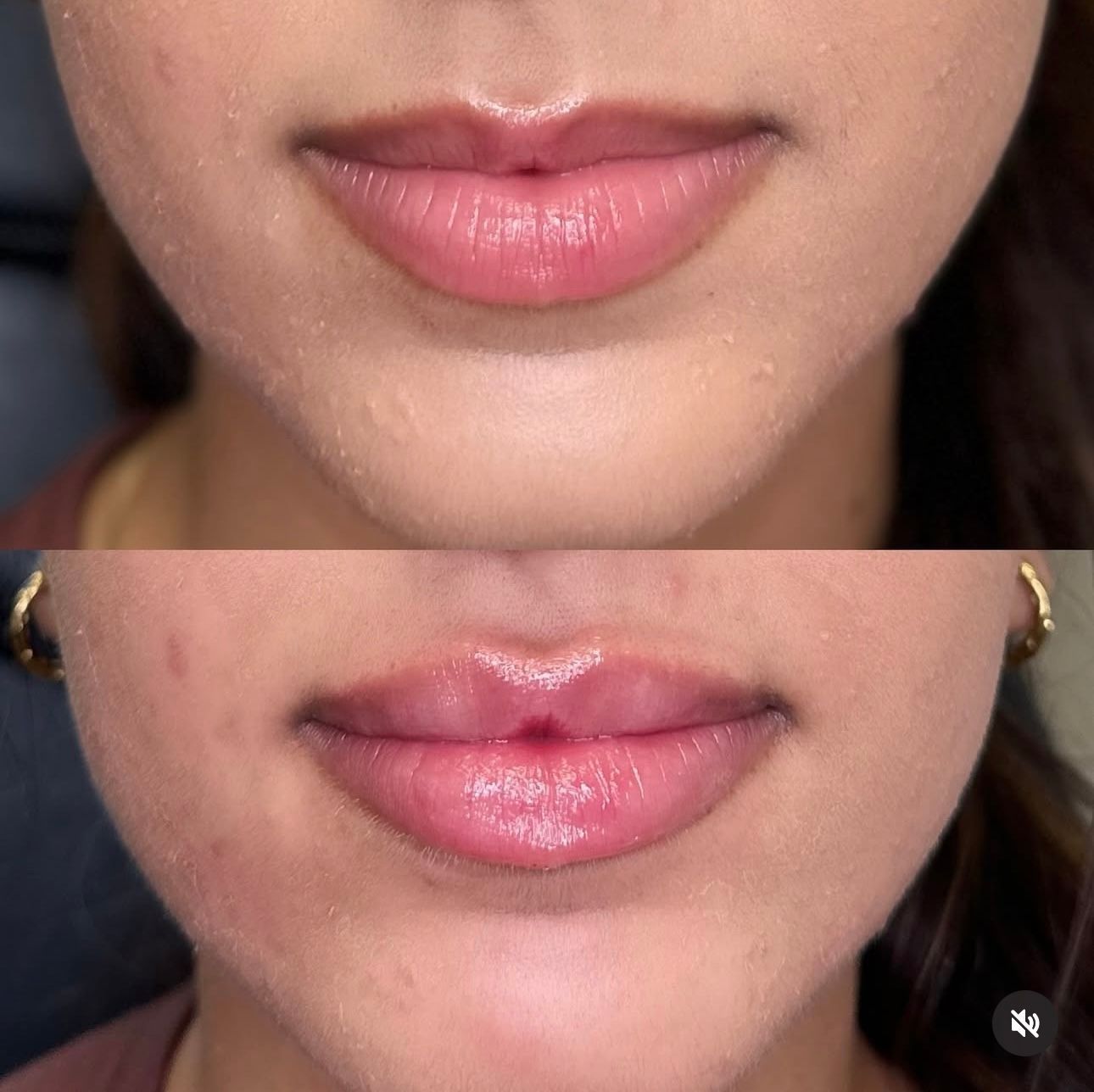 Close-up of lips before and after treatment, showing fuller, glossier pink lips on the bottom.