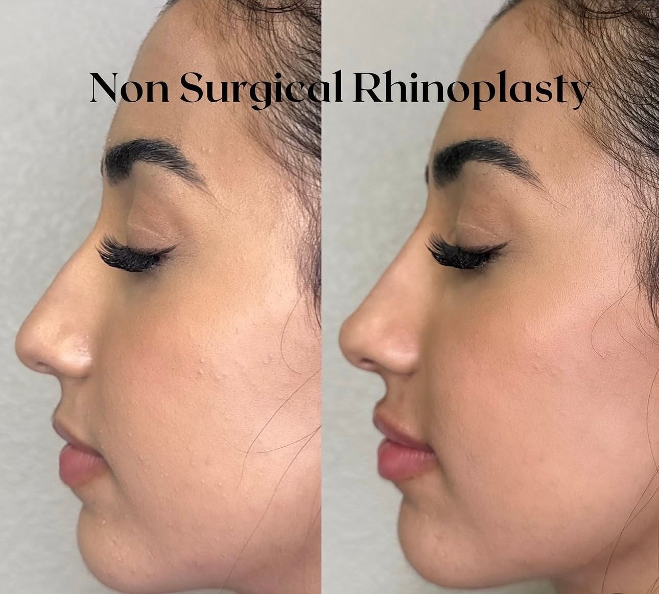 Before-and-after side profile of a nose, labeled “Non Surgical Rhinoplasty.”