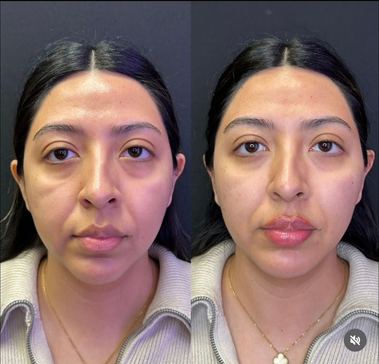 Side-by-side portrait comparing a face before and after a cosmetic treatment, with slight lip and under-eye changes.