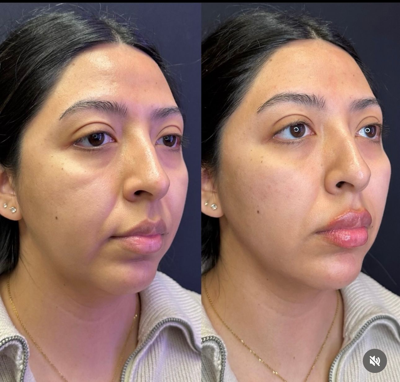 Side-by-side facial profile comparison of the same woman in a beige sweater, before and after makeup or treatment