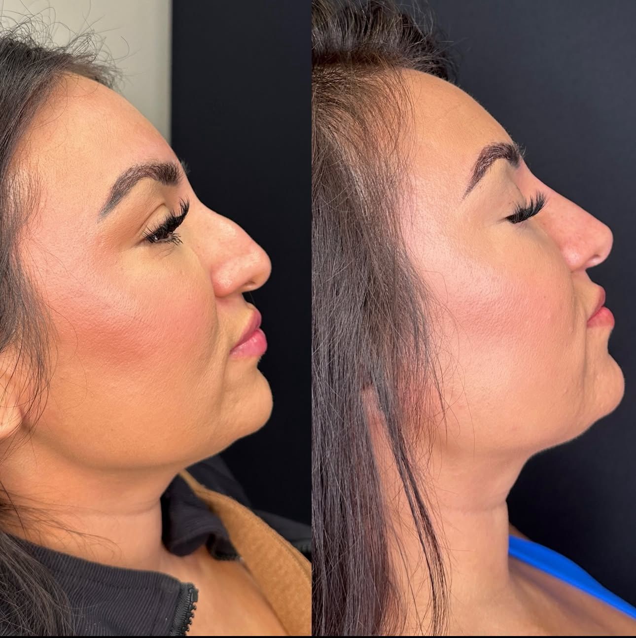 Side-by-side profile photos of a woman with a straighter jawline after a cosmetic treatment