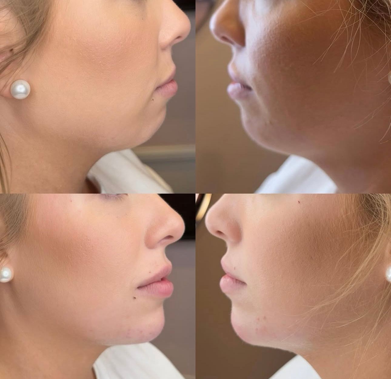Side-profile comparison of two women facing each other, showing upper and lower lip changes.