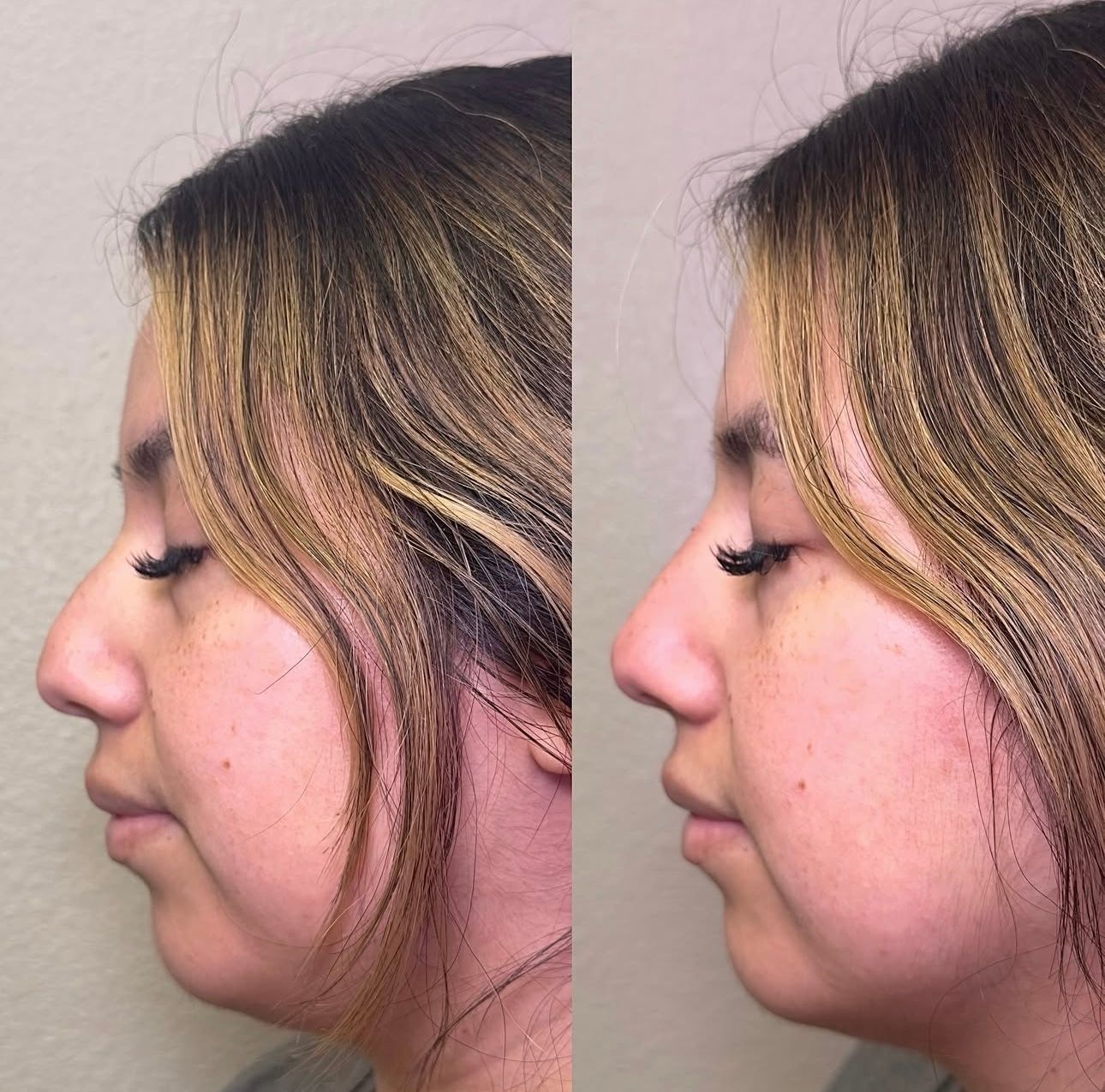 Side-by-side profile photos of the same woman with dark hair, showing the nose before and after surgery.
