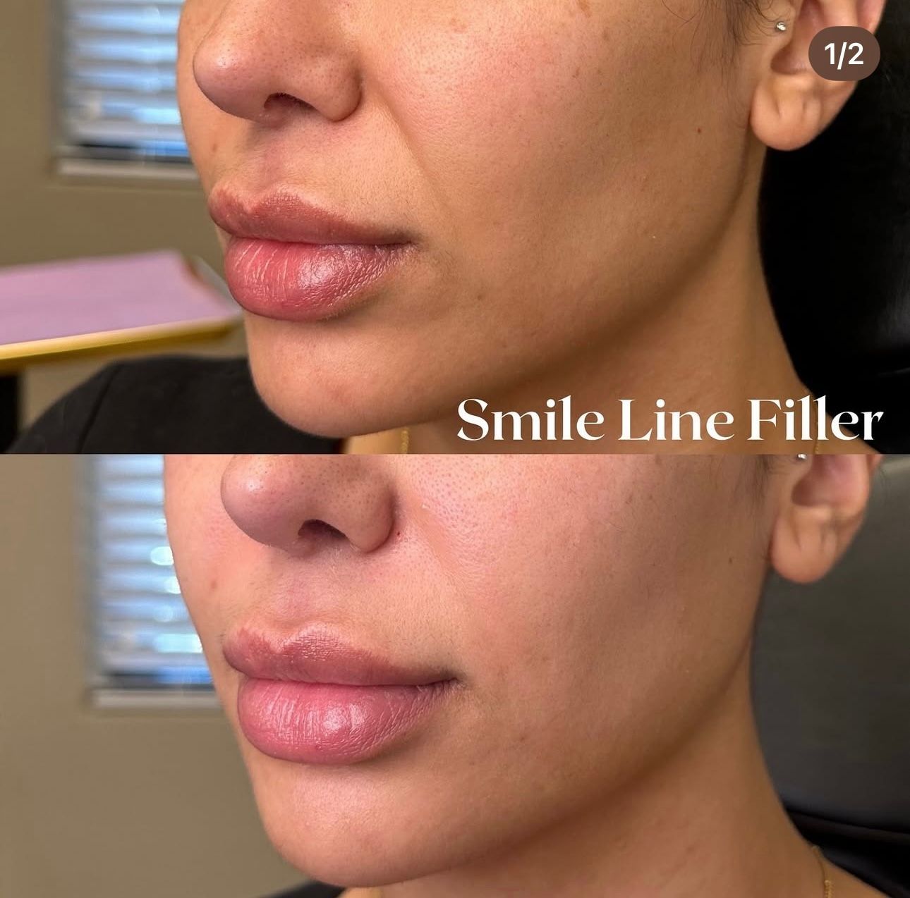 Before-and-after close-up of lips and smile lines after filler treatment