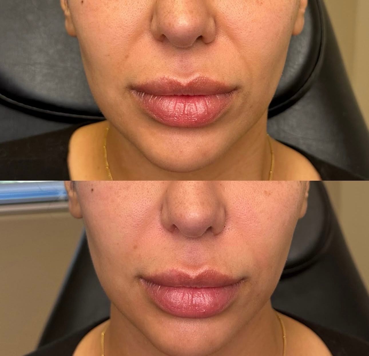 Close-up before-and-after of a person’s lips and lower face, showing improved lip fullness.