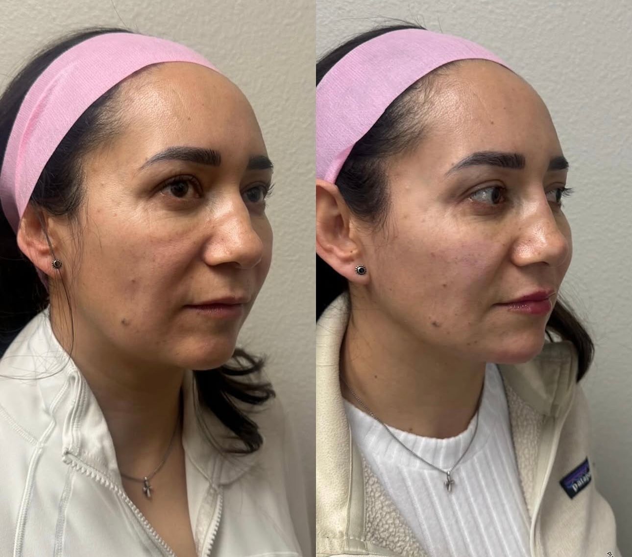 Side-by-side facial profile photos of a woman with a pink headband, neutral expression, in a clinical setting