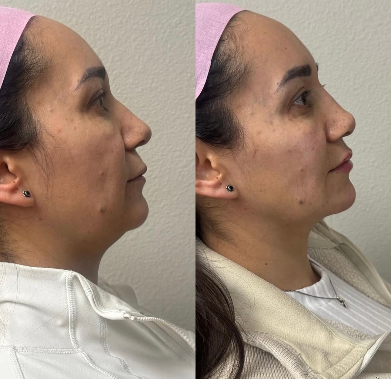 Side-by-side profile photos of the same woman before and after a cosmetic facial change.