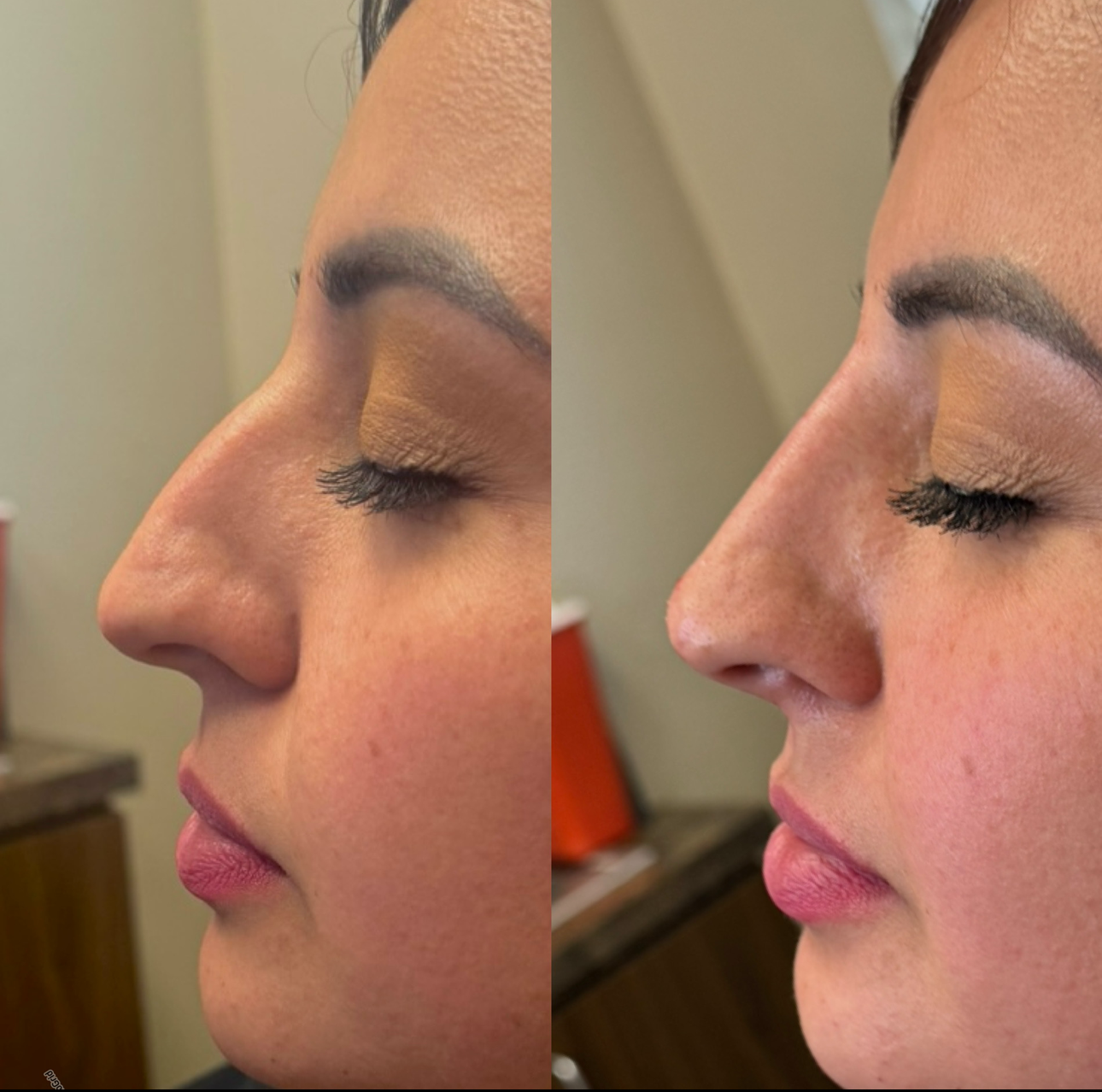 Side-profile comparison of a woman’s nose before and after a cosmetic change