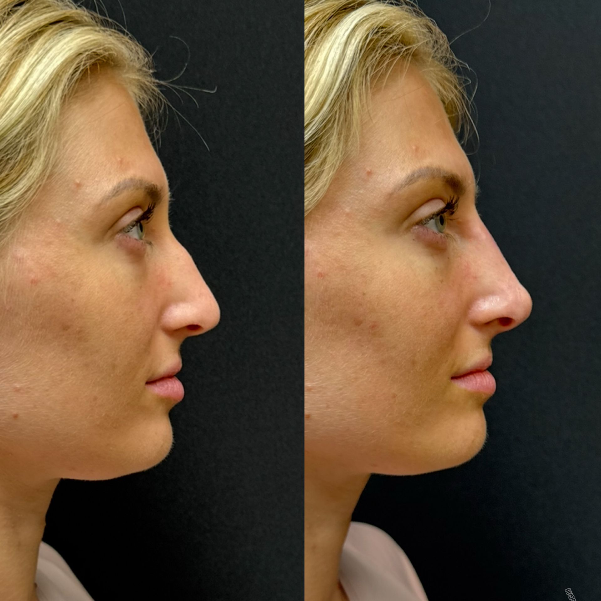 Side-by-side profile photos of the same blonde woman against a dark background, showing facial changes.