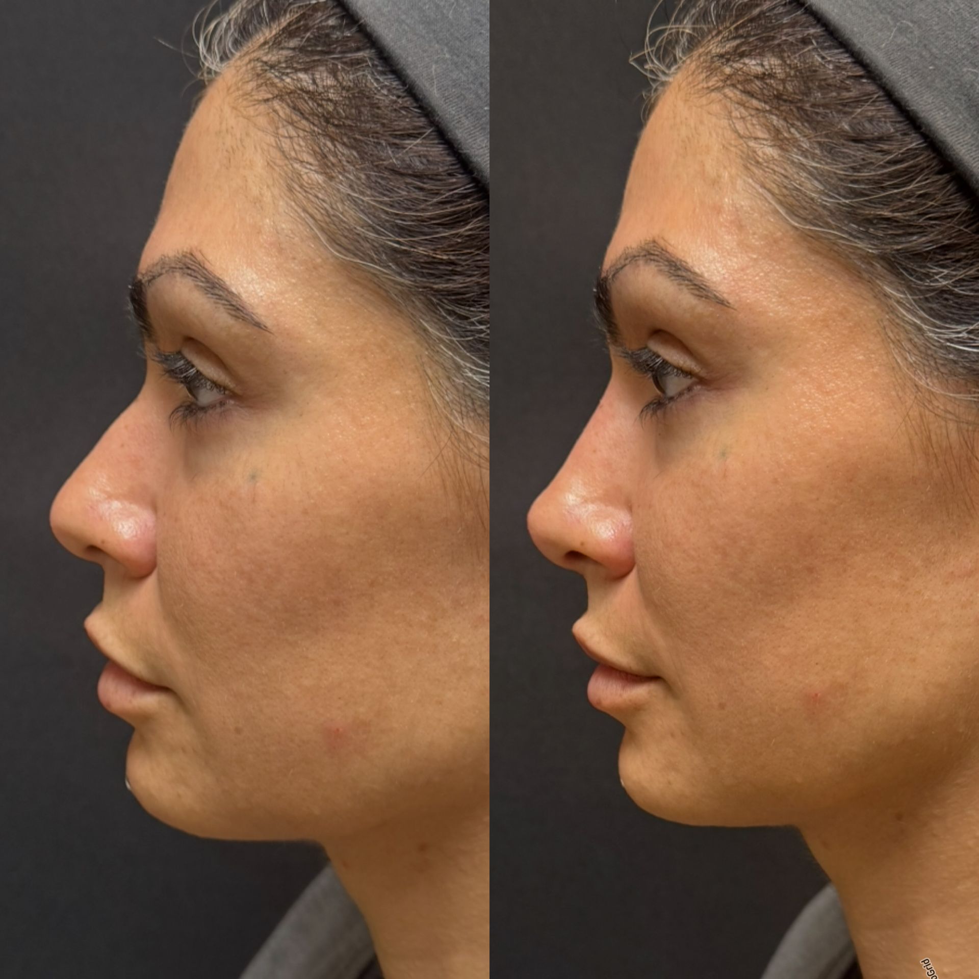 Side-by-side profile views of a woman’s face, showing a before-and-after comparison of jawline and chin shape.