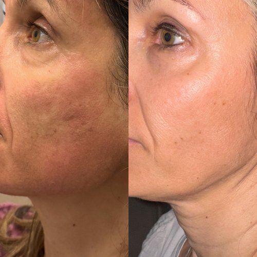 Side-by-side close-up of a cheek before and after treatment, showing smoother skin on the right