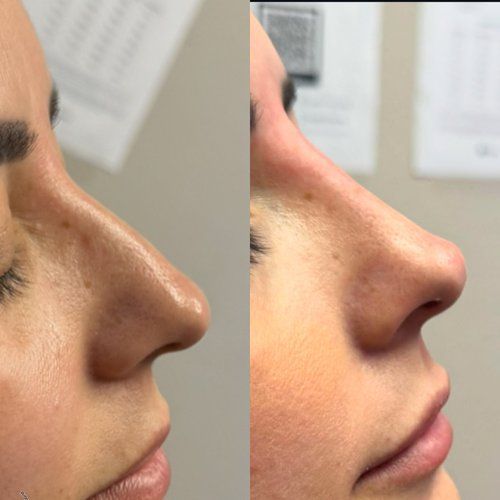 Side-by-side profile close-ups of a nose before and after cosmetic contouring.