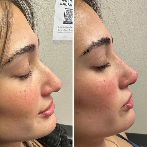 Side-by-side profile photos of a person with a red, swollen nose and cheek before and after treatment