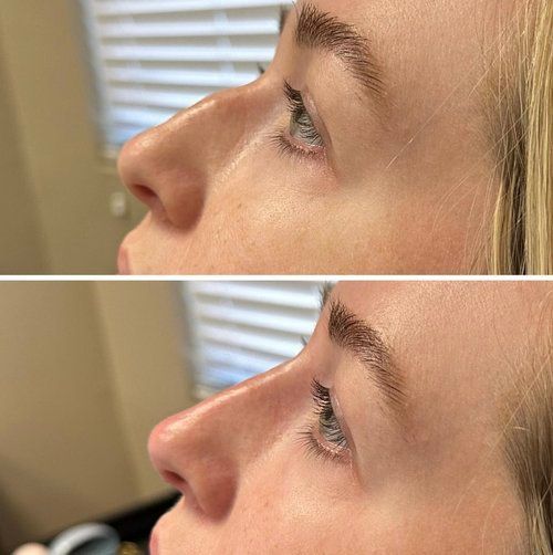 Side-by-side profile close-up of a person’s nose before and after treatment, with less redness below.