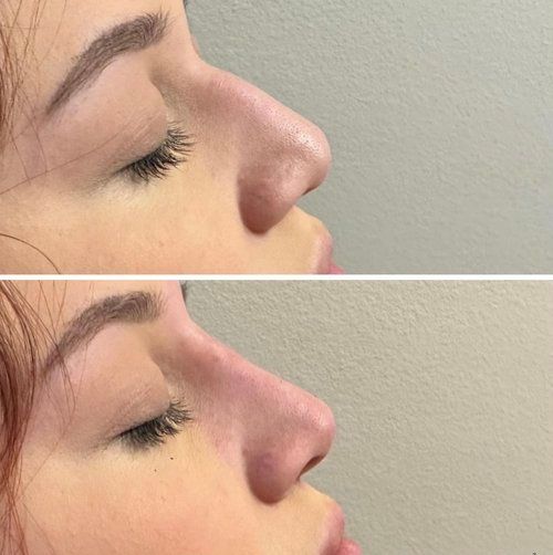 Side-by-side profile close-up of a nose before and after rhinoplasty, showing a smaller bridge.