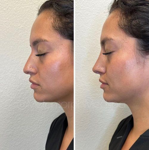 Side-by-side profile photos showing facial profile changes, with eyes closed, against a plain wall.