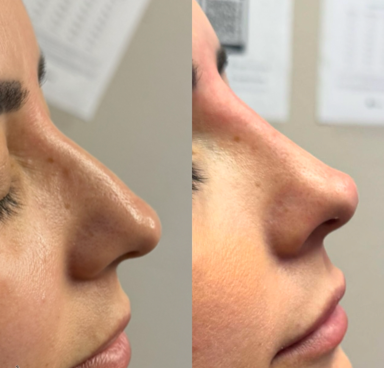 Side-profile comparison of a nose before and after cosmetic refinement, shown on two adjacent face close-ups.