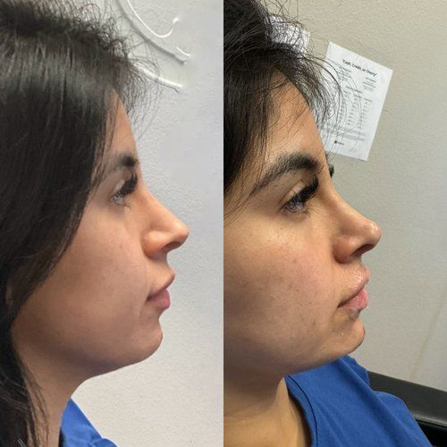 Side-by-side profile views of a person’s face against a light wall, wearing a blue shirt.