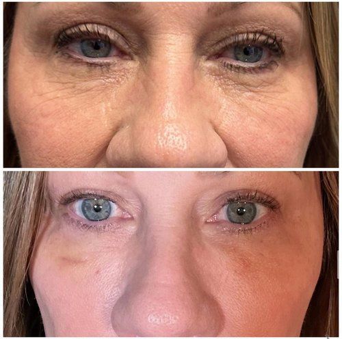 Before-and-after close-up of eyes and nose showing reduced under-eye wrinkles and redness