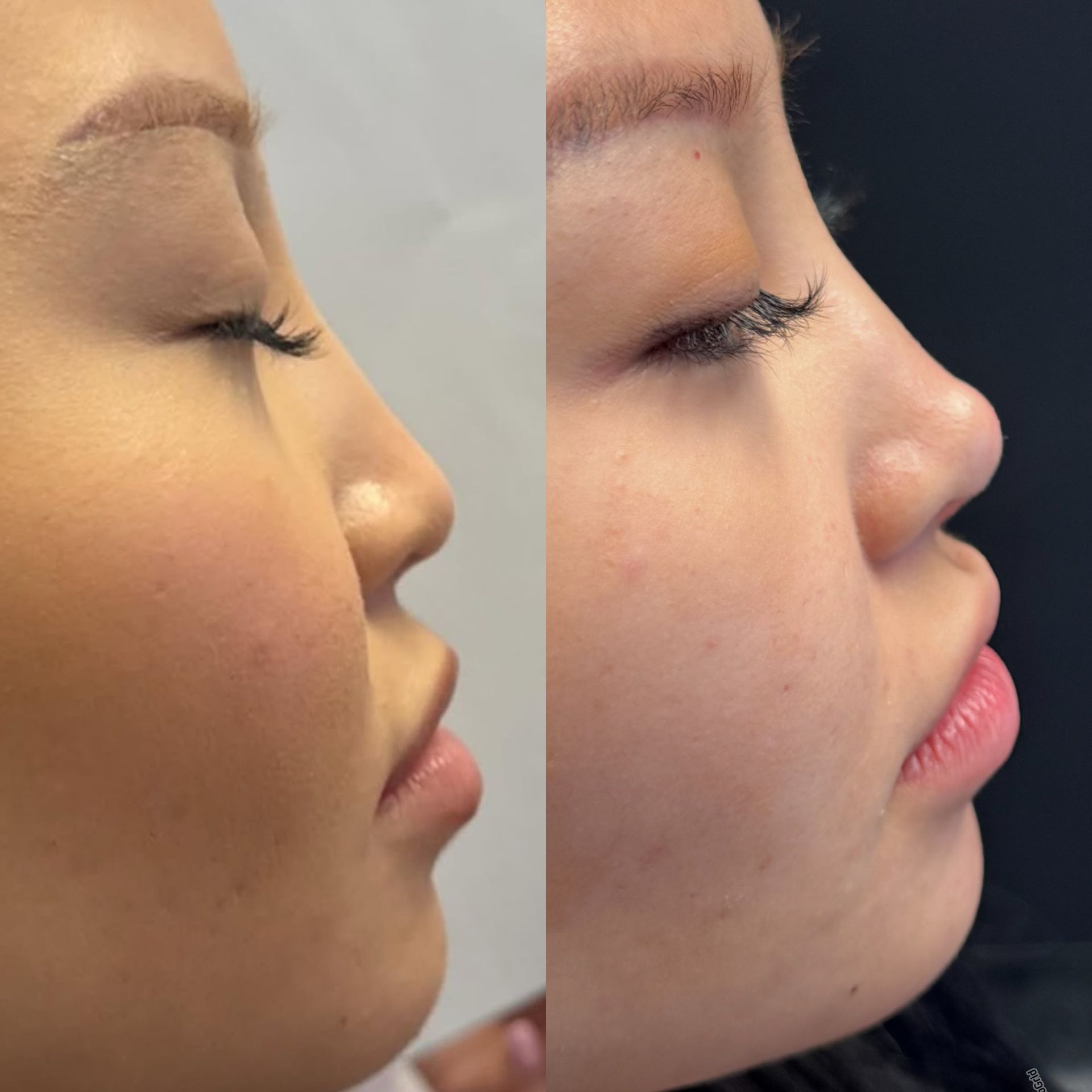 Side-by-side profile close-ups of a face showing nose shape before and after cosmetic change