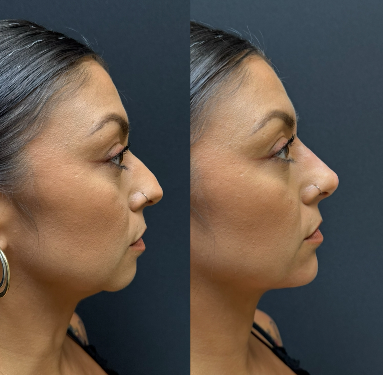 Side-by-side profile photos of a woman before and after cosmetic facial surgery.