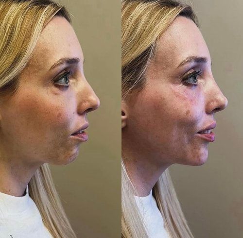 Side-by-side profile portraits of the same blonde woman, showing before-and-after facial skin changes.