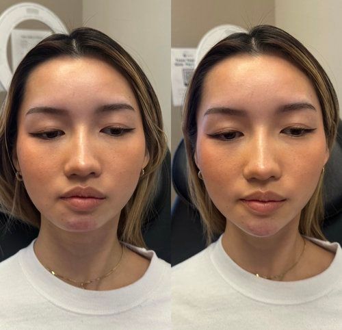 Side-by-side portraits of the same woman with neutral expression, showing before-and-after facial contour changes.
