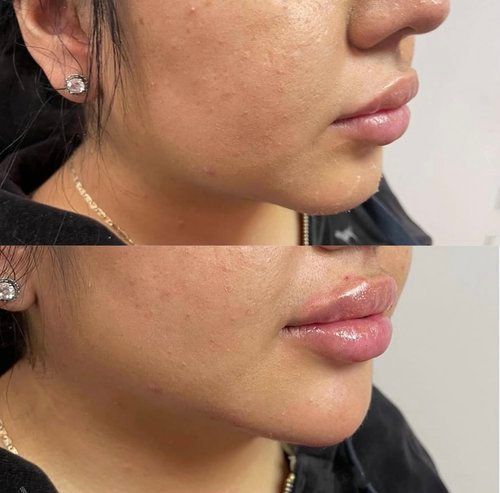 Side-by-side profile close-up showing lips before and after cosmetic filler treatment.