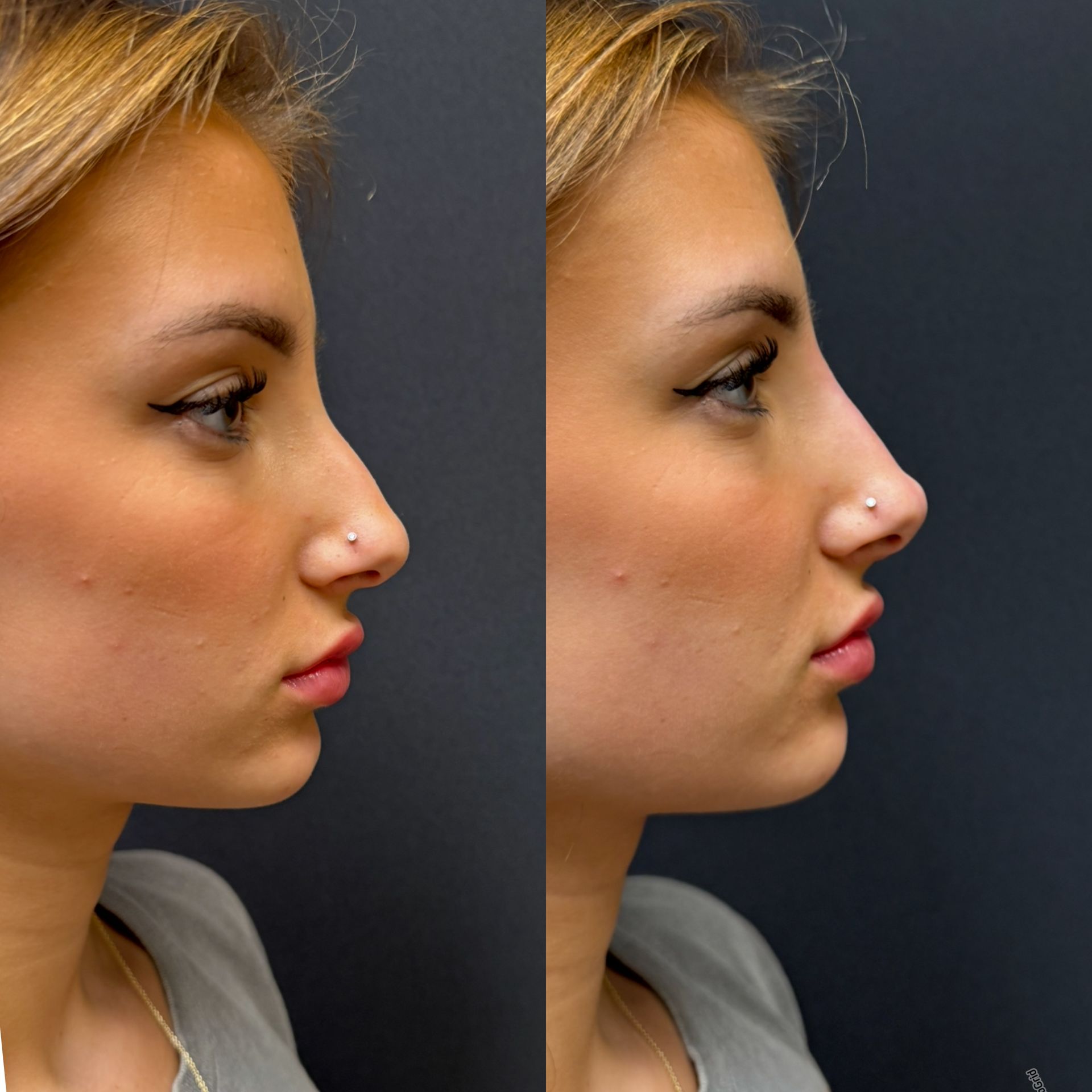 Side-by-side profile photos of a woman with a nose piercing against a dark background
