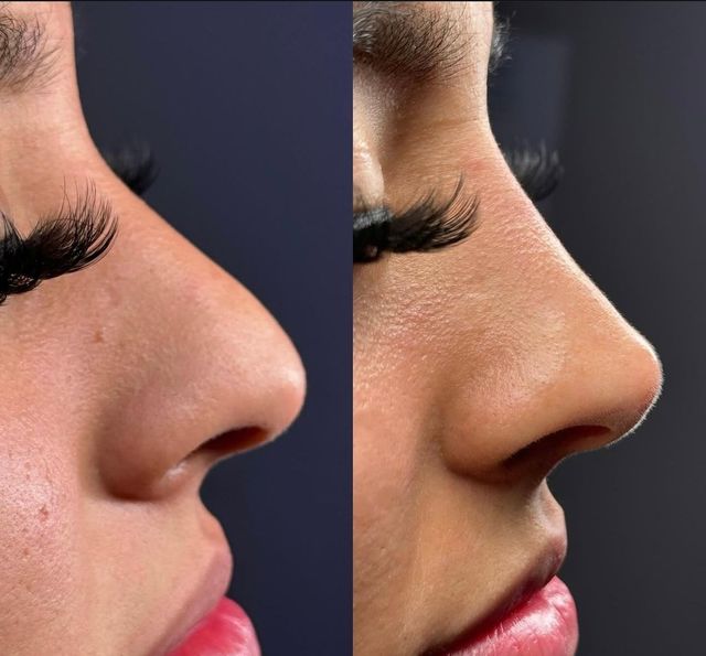 Non-Surgical Nose Job | Plano, TX
