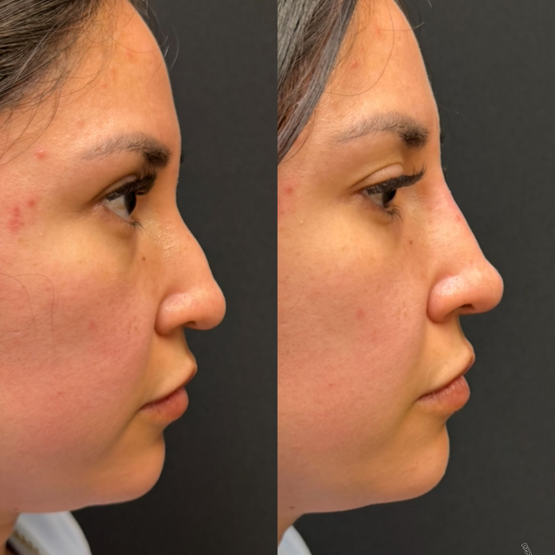 Side-by-side profile photos of a woman’s face before and after cosmetic changes.