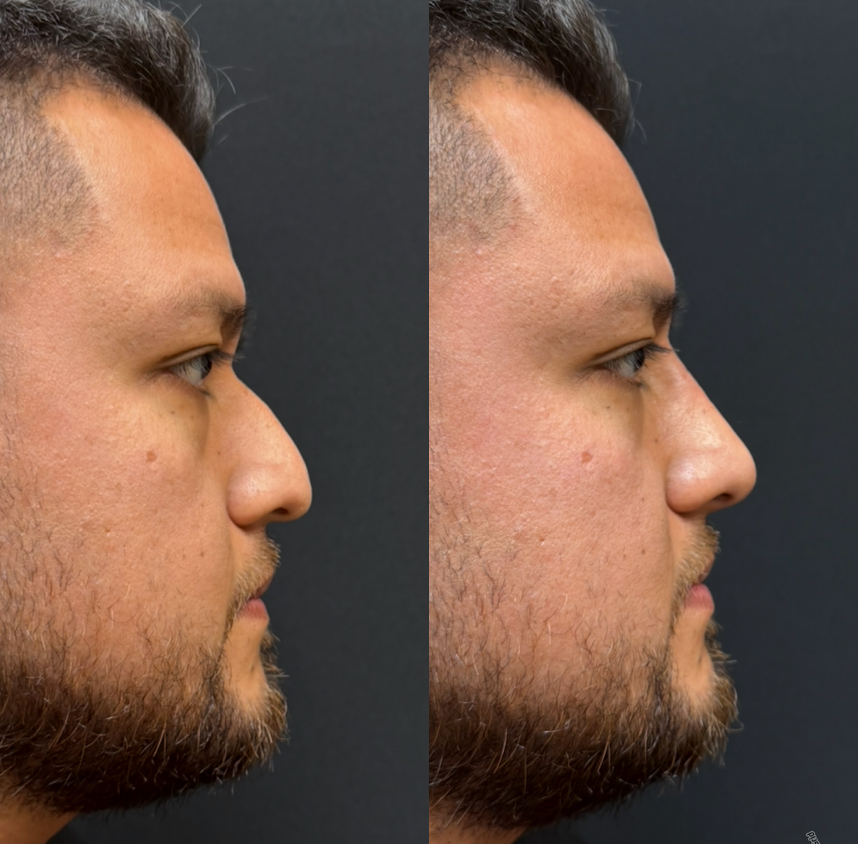 Side-by-side profile photos of a bearded man, showing before-and-after facial profile comparison