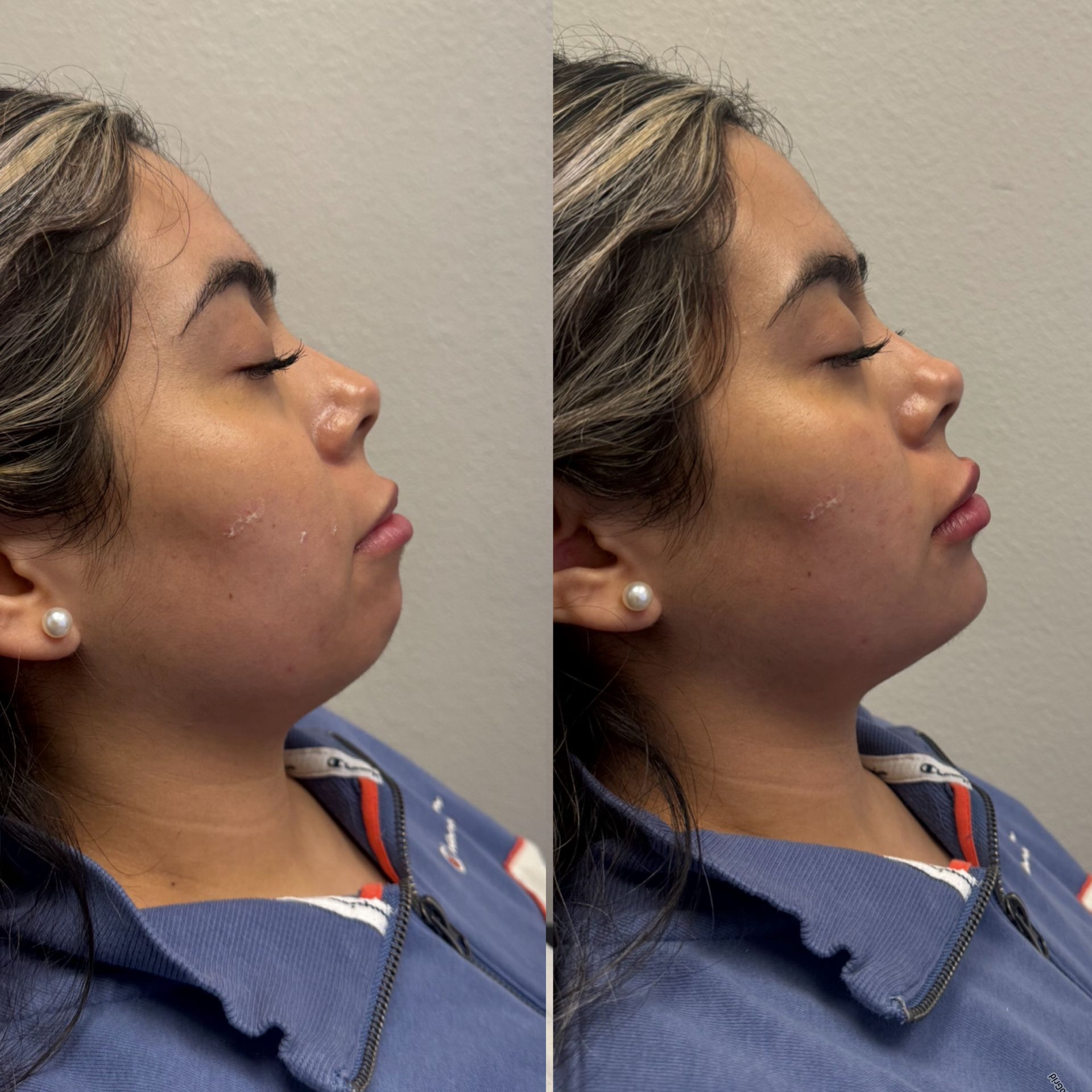 Side-by-side profile views of the same woman in a blue top against a plain wall, lips slightly pursed.