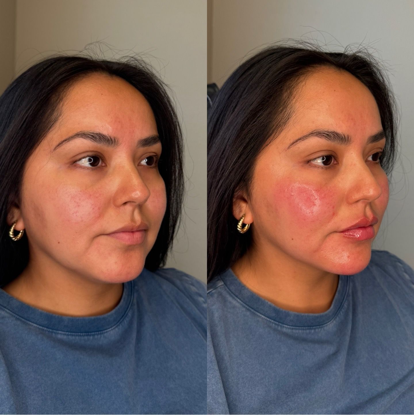 Side-by-side portrait of a person before and after facial redness treatment, wearing a blue shirt.