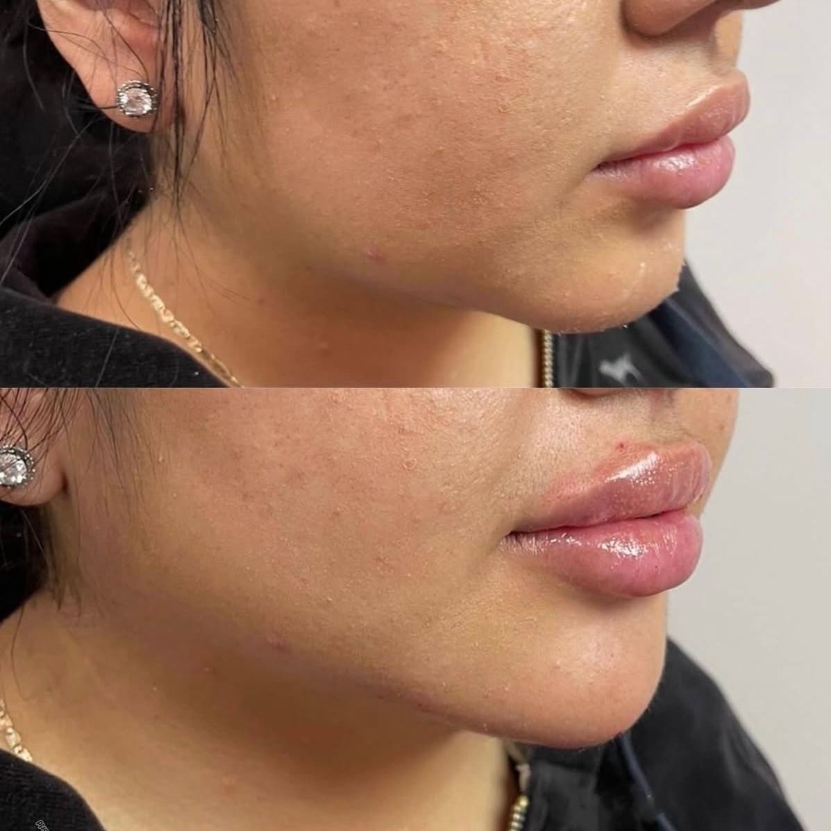 Side-by-side close-up of lips and chin before and after treatment, showing fuller, glossier lips.