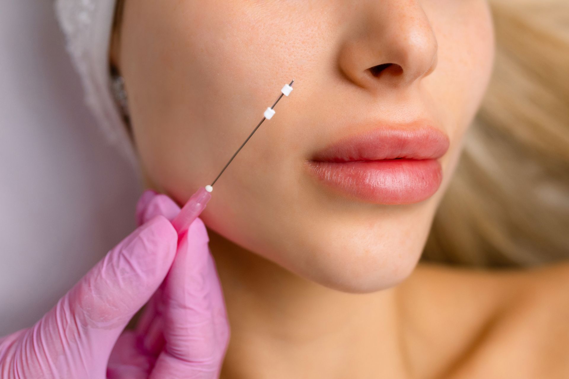 Gloved hand injecting filler into a person’s cheek with a fine needle